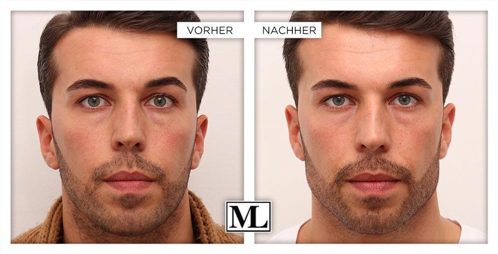 Krahenfusse Behandlung Fur Manner Ohne Op Mascu Look